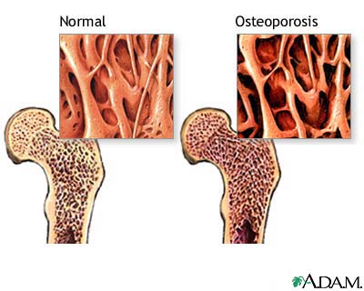 Osteoporosis-enfermedad-ósea