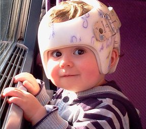 Es recomendable el casco ortopédico en niños con plagiocefalia leve o  moderada?