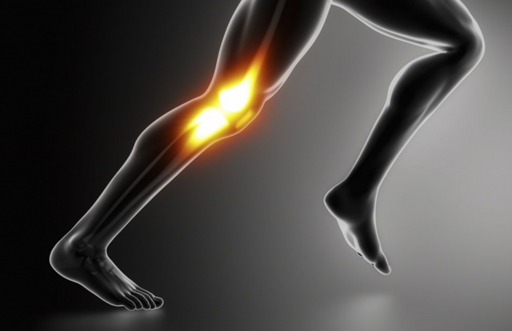 Síndrome de la cintilla iliotibial en corredores