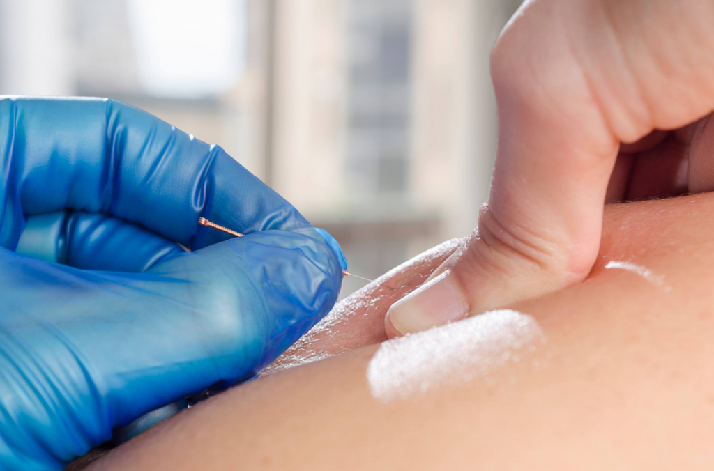 Fisioterapia invasiva: qué técnicas incluye y cuándo se utiliza