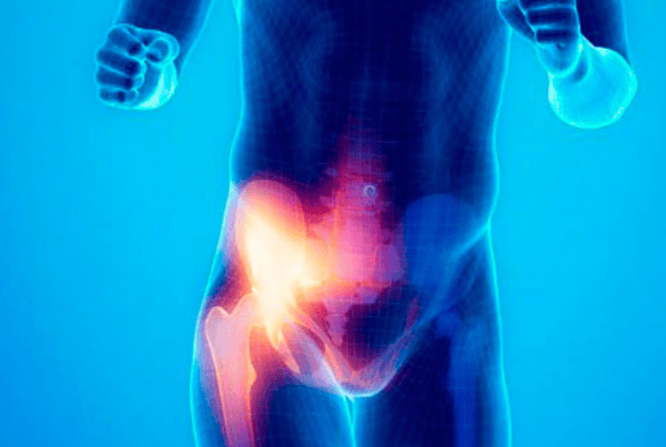 Ilustración del dolor en la ingle por pubalgia en un deportista
